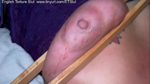 Bruised tits