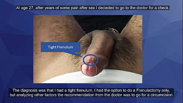 Circumcised sex video